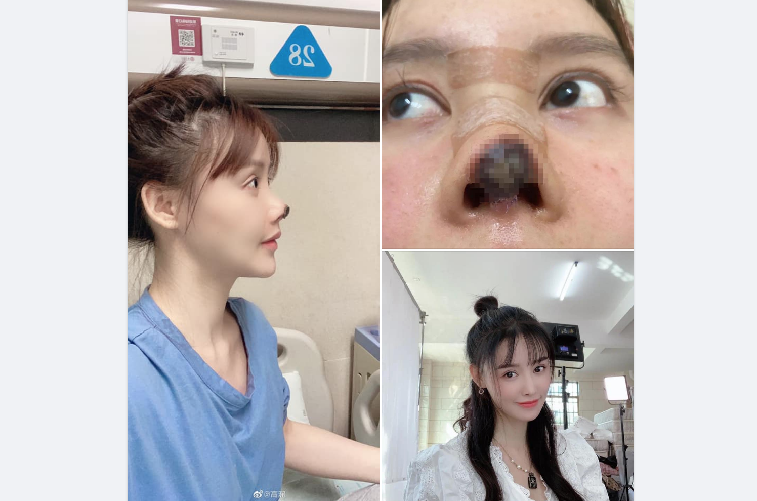 Chinese star gao liu shares photos of 'nightmare' nose surgery